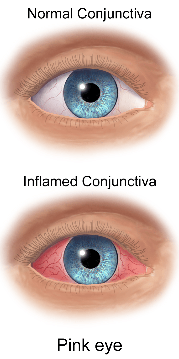 A conjuntiva é a membrana fina que cobre a parte branca do olho. Inflamada, ela fica vermelha e com os vasos sanguíneos bem mais visíveis — daí o nome popular "olho vermelho".