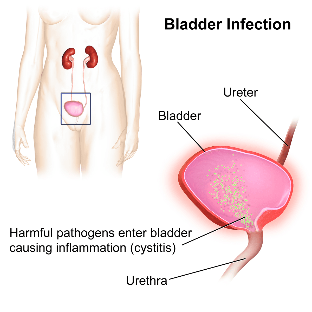 Bactérias entram pela uretra e sobem até a bexiga, causando a inflamação (cistite) — é esse trajeto mais curto que explica por que a ITU é bem mais comum em mulheres.