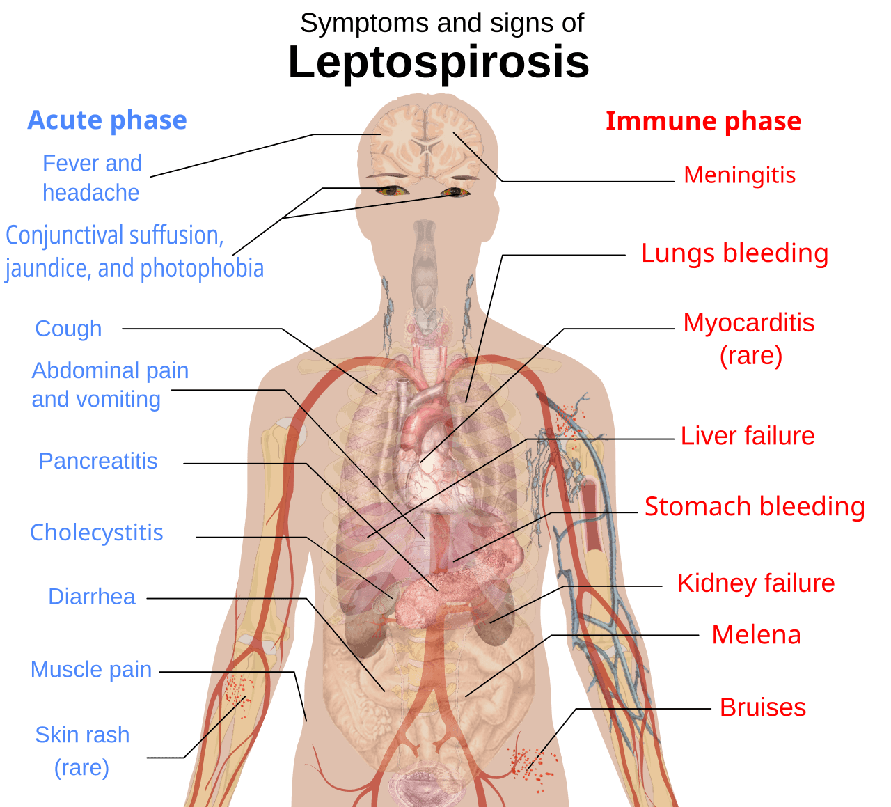 Principais sinais e sintomas da leptospirose na fase aguda (febre, dor de cabeça, dor muscular) e na fase imune, mais grave, quando pode evoluir para a síndrome de Weil.