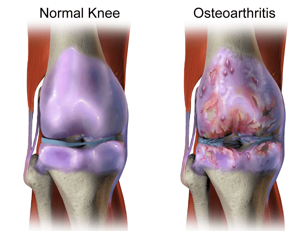 A cartilagem que protege a articulação vai desgastando aos poucos — o joelho com osteoartrite (à direita) perde a superfície lisa que amortece o movimento.