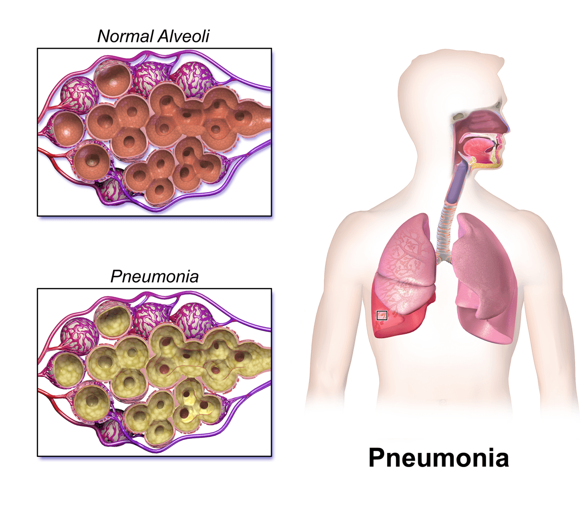 Comparação entre alvéolos pulmonares normais e alvéolos preenchidos por líquido e células inflamatórias na pneumonia bacteriana, o que dificulta as trocas gasosas.
