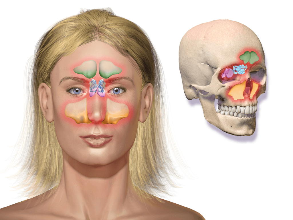 Os seios da face são cavidades ao redor do nariz e dos olhos (destacadas em cores). Quando inflamam, a dor e a pressão aparecem exatamente nessas regiões.